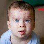 Chickenpox in children
