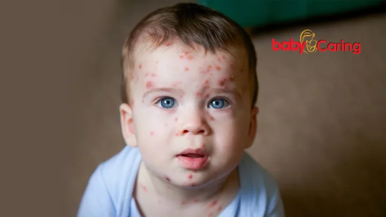 Chickenpox in children