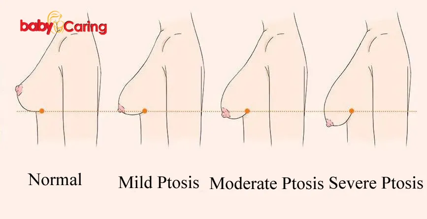 Sagging Breasts Ptosis Classification
