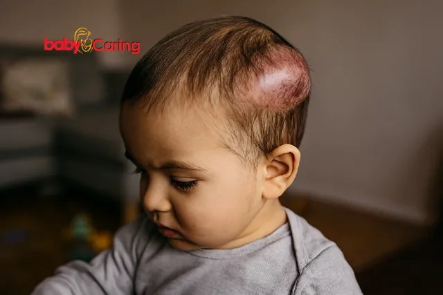 Scalp Hematoma in toddler